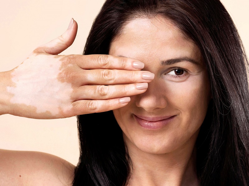 Dia Mundial do Vitiligo reforça importância do maior esclarecimento à população